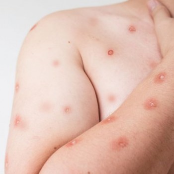 Mpox em Presidente Prudente: como reconhecer sinais e prevenir a transmissão
